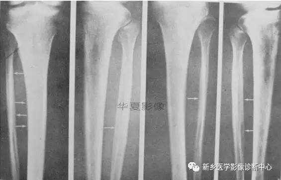 下肢骨,你应该想到的48种变异 下肢骨,你应该想到的48种变异