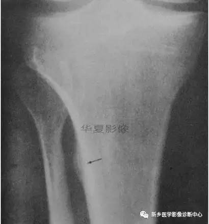 下肢骨,你应该想到的48种变异 下肢骨,你应该想到的48种变异