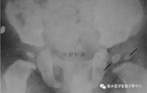 下肢骨,你应该想到的48种变异 下肢骨,你应该想到的48种变异