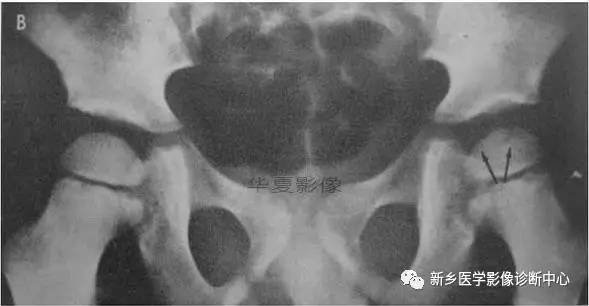 下肢骨,你应该想到的48种变异 下肢骨,你应该想到的48种变异