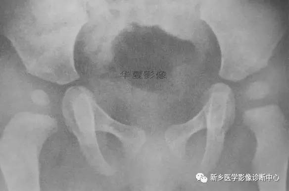 下肢骨,你应该想到的48种变异 下肢骨,你应该想到的48种变异