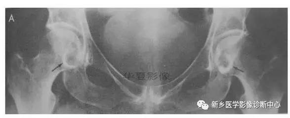 下肢骨,你应该想到的48种变异 下肢骨,你应该想到的48种变异