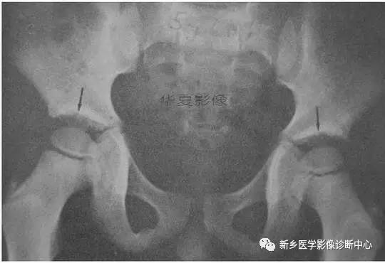 下肢骨,你应该想到的48种变异 下肢骨,你应该想到的48种变异
