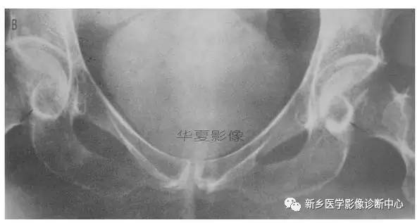 下肢骨,你应该想到的48种变异 下肢骨,你应该想到的48种变异