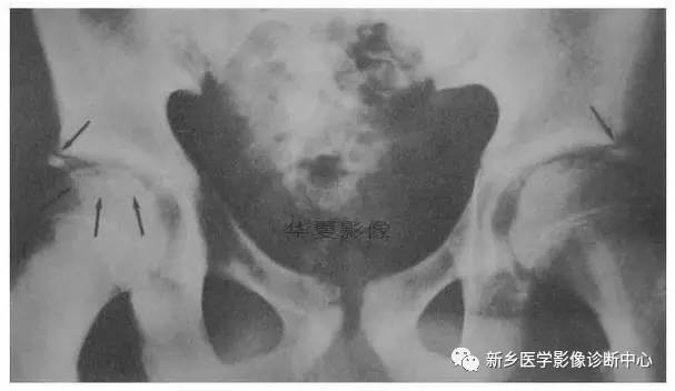 下肢骨,你应该想到的48种变异 下肢骨,你应该想到的48种变异