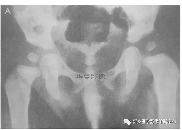 下肢骨,你应该想到的48种变异 下肢骨,你应该想到的48种变异