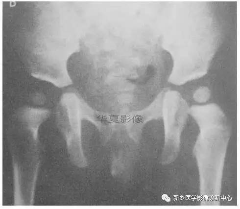 下肢骨,你应该想到的48种变异 下肢骨,你应该想到的48种变异