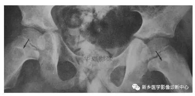 下肢骨,你应该想到的48种变异 下肢骨,你应该想到的48种变异