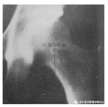 下肢骨,你应该想到的48种变异 下肢骨,你应该想到的48种变异
