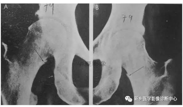 下肢骨,你应该想到的48种变异 下肢骨,你应该想到的48种变异
