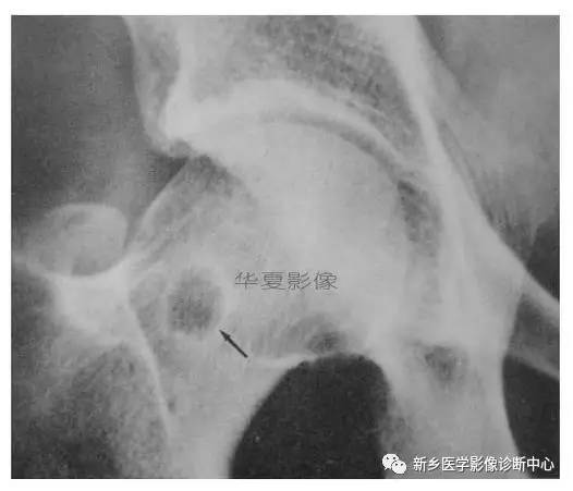 下肢骨,你应该想到的48种变异 下肢骨,你应该想到的48种变异
