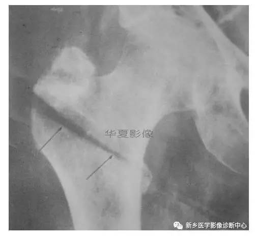 下肢骨,你应该想到的48种变异 下肢骨,你应该想到的48种变异