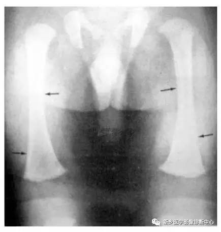 下肢骨,你应该想到的48种变异 下肢骨,你应该想到的48种变异