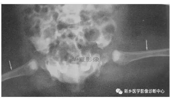 下肢骨,你应该想到的48种变异 下肢骨,你应该想到的48种变异