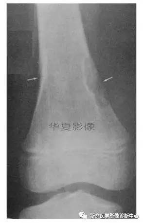 下肢骨,你应该想到的48种变异 下肢骨,你应该想到的48种变异