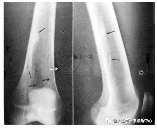 下肢骨,你应该想到的48种变异 下肢骨,你应该想到的48种变异