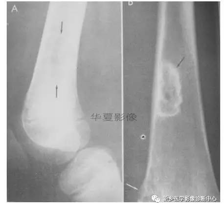 下肢骨,你应该想到的48种变异 下肢骨,你应该想到的48种变异