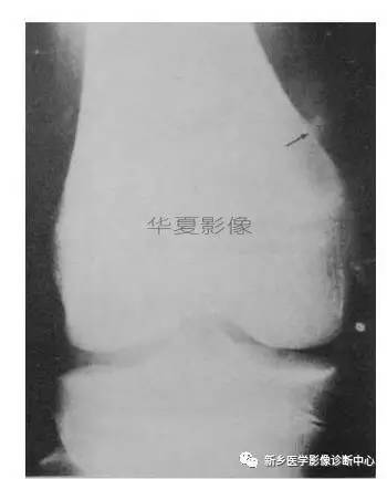 下肢骨,你应该想到的48种变异 下肢骨,你应该想到的48种变异