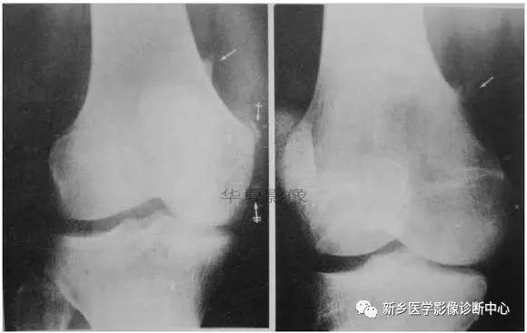 下肢骨,你应该想到的48种变异 下肢骨,你应该想到的48种变异