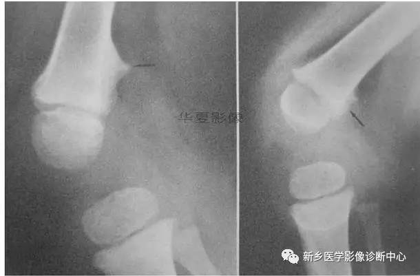 下肢骨,你应该想到的48种变异 下肢骨,你应该想到的48种变异