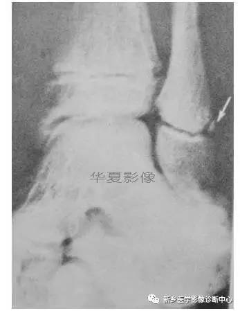 下肢骨，你应该想到的48种变异