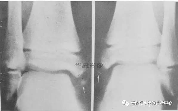 下肢骨,你应该想到的48种变异 下肢骨,你应该想到的48种变异