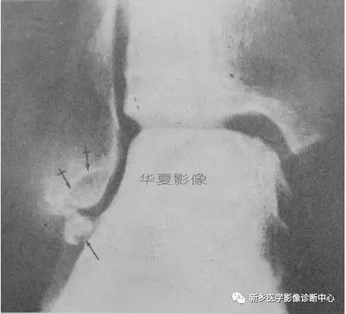 下肢骨，你应该想到的48种变异