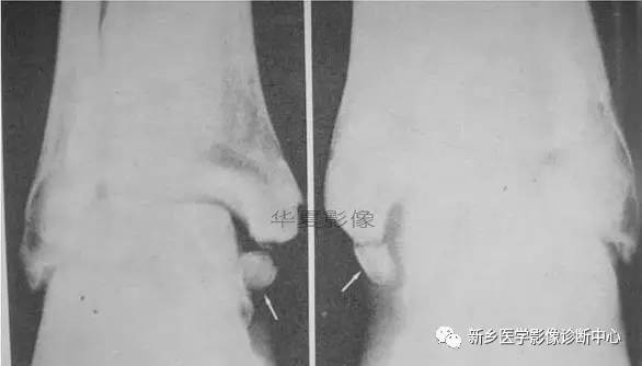 下肢骨,你应该想到的48种变异 下肢骨,你应该想到的48种变异