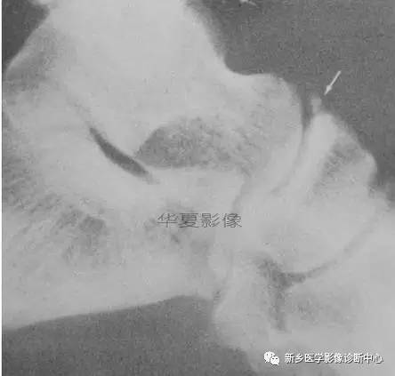 下肢骨,你应该想到的48种变异 下肢骨,你应该想到的48种变异