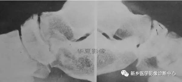下肢骨,你应该想到的48种变异 下肢骨,你应该想到的48种变异