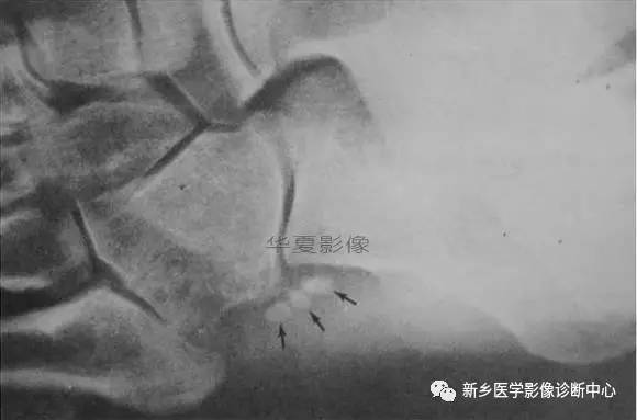 下肢骨，你应该想到的48种变异