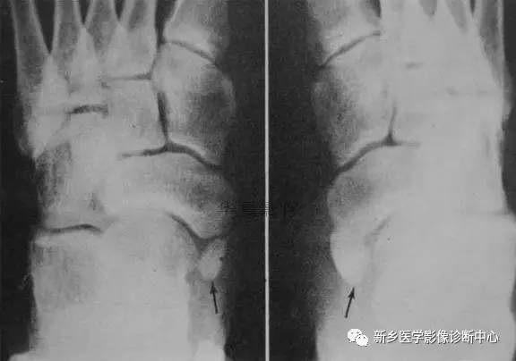 下肢骨，你应该想到的48种变异