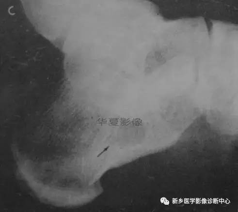 下肢骨，你应该想到的48种变异