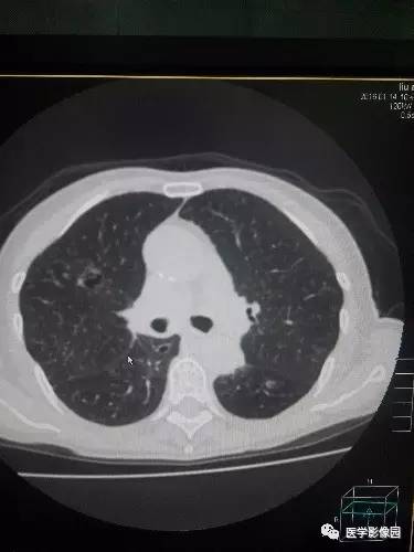 【病例】胸壁弹力纤维瘤1例CT影像表现