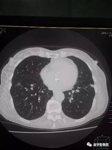 【病例】胸壁弹力纤维瘤1例CT影像表现