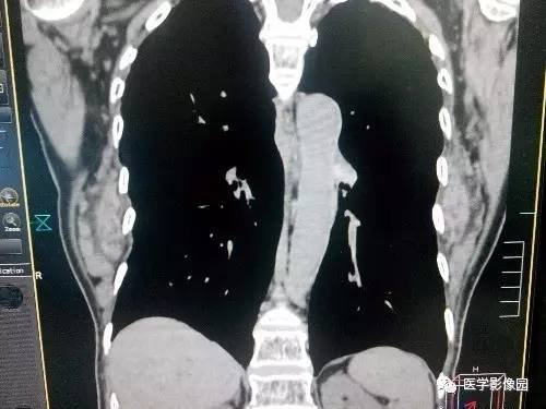 【病例】胸壁弹力纤维瘤1例CT影像表现