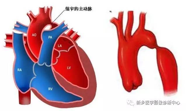 11种主动脉弓部畸形，您都了解吗？