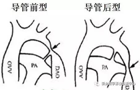 11种主动脉弓部畸形，您都了解吗？