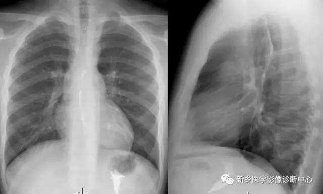 11种主动脉弓部畸形，您都了解吗？