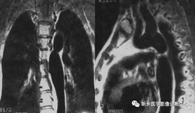 11种主动脉弓部畸形，您都了解吗？