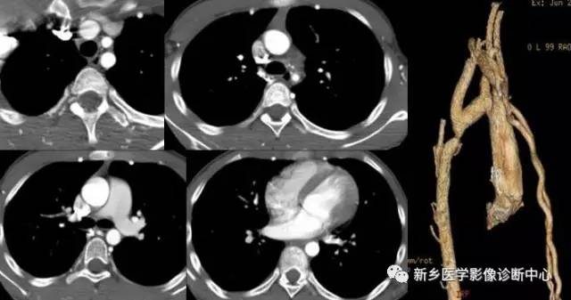 11种主动脉弓部畸形，您都了解吗？