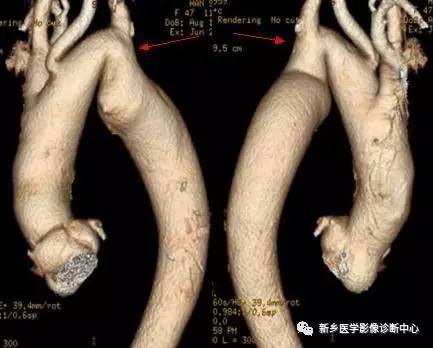 11种主动脉弓部畸形，您都了解吗？
