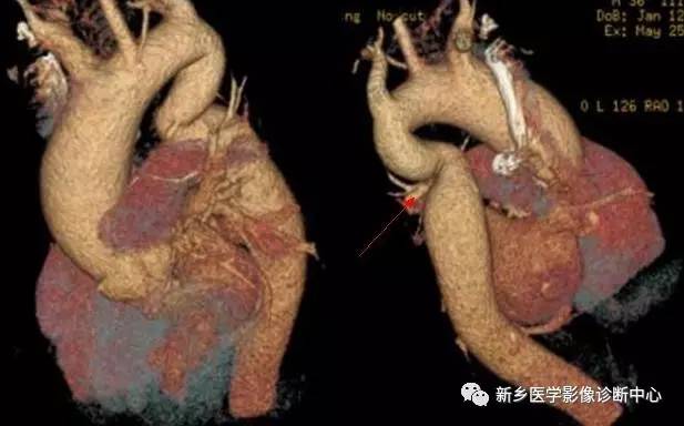 11种主动脉弓部畸形，您都了解吗？