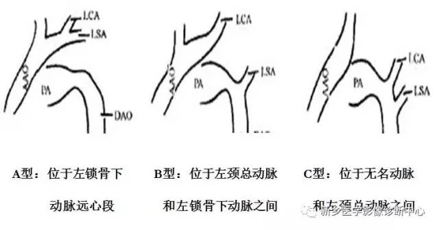 11种主动脉弓部畸形，您都了解吗？