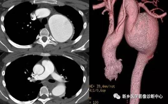 11种主动脉弓部畸形，您都了解吗？