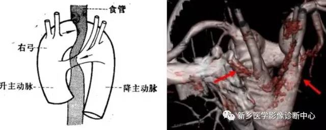11种主动脉弓部畸形，您都了解吗？