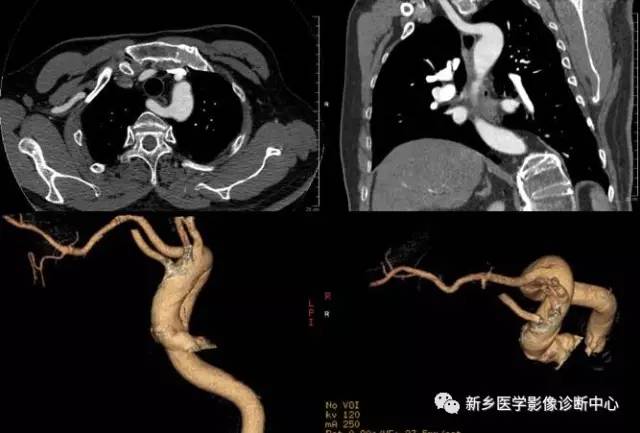11种主动脉弓部畸形，您都了解吗？