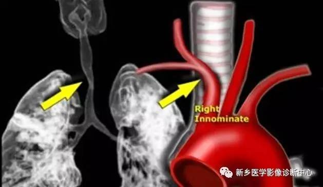 11种主动脉弓部畸形，您都了解吗？
