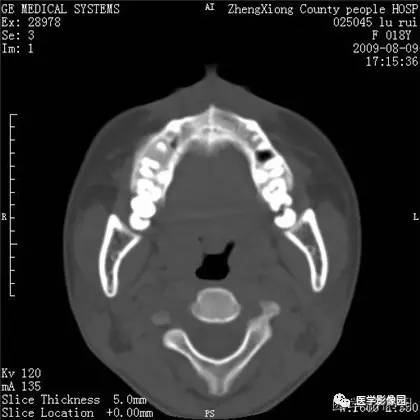 【病例】颌骨骨化性纤维瘤1例CT 【病例】颌骨骨化性纤维瘤1例CT