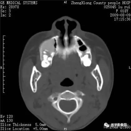 【病例】颌骨骨化性纤维瘤1例CT 【病例】颌骨骨化性纤维瘤1例CT